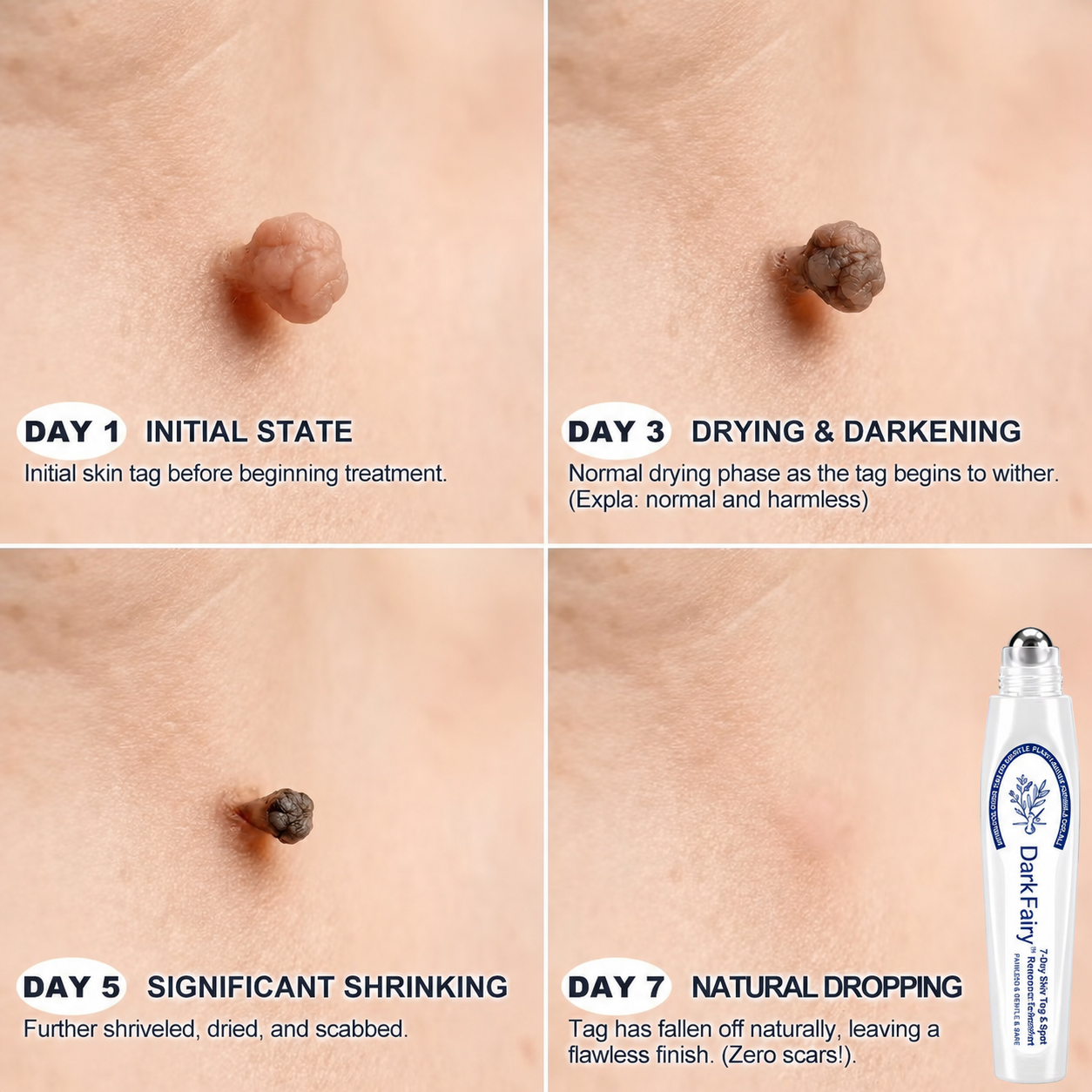 𝘿𝙖𝙧𝙠𝙁𝙖𝙞𝙧𝙮™👩‍⚕️ 𝟕-𝐃𝒂𝘆 𝐒𝗸𝐢𝐧 𝐓𝒂𝗴 & 𝐒𝐩𝙤𝐭 𝐄𝐫𝒂𝐬𝙚𝐫 Painless & Scar-Free Advanced Imperfection Removal Rollerball Pen