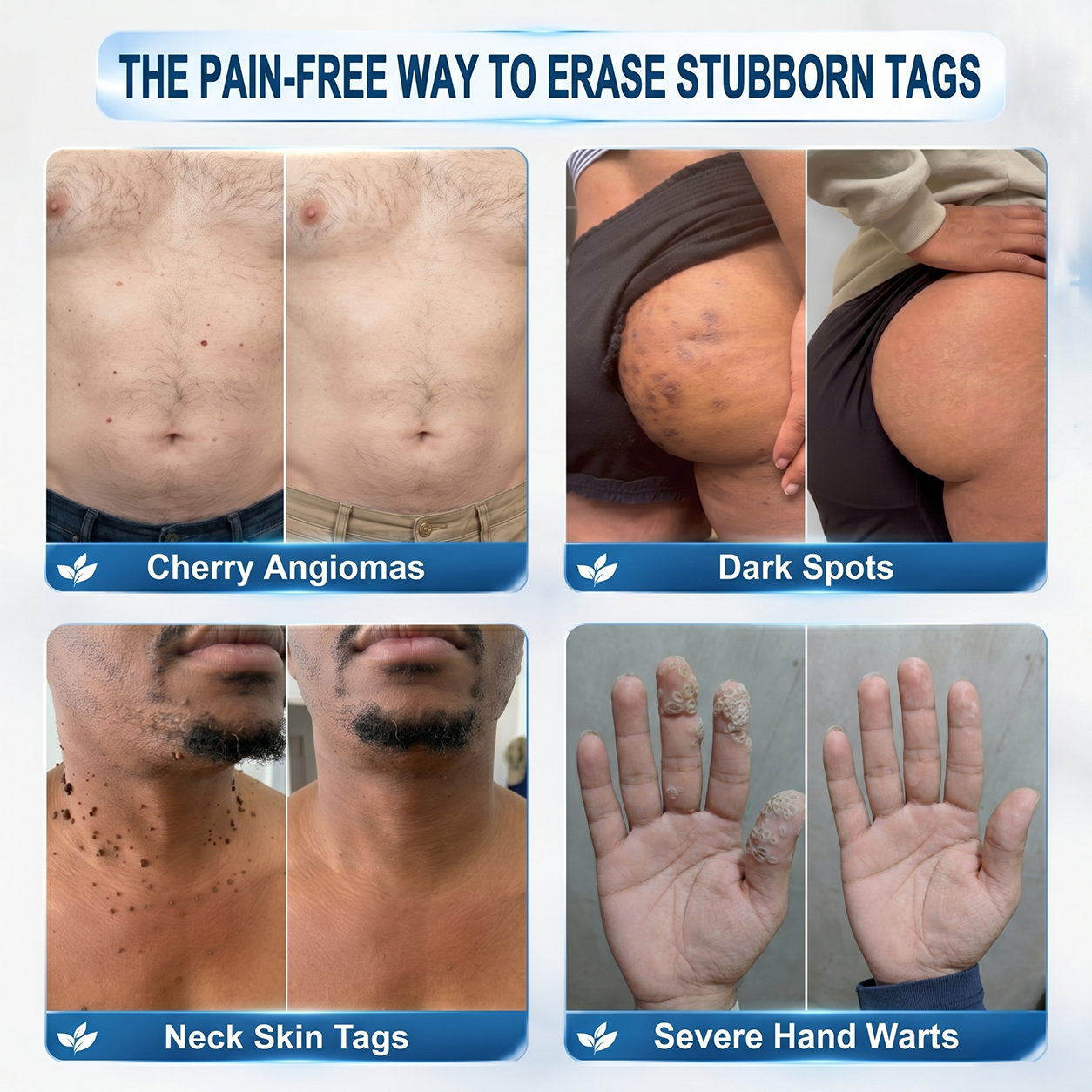 𝘿𝙖𝙧𝙠𝙁𝙖𝙞𝙧𝙮®👩‍⚕️ 𝟕-𝐃𝒂𝘆 𝐒𝗸𝐢𝐧 𝐓𝒂𝗴 & 𝐒𝐩𝙤𝐭 𝐄𝐫𝒂𝐬𝙚𝐫 Painless & Scar-Free Advanced Imperfection Removal Rollerball Pen