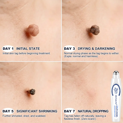 𝘿𝙖𝙧𝙠𝙁𝙖𝙞𝙧𝙮®👩‍⚕️ 𝟕-𝐃𝒂𝘆 𝐒𝗸𝐢𝐧 𝐓𝒂𝗴 & 𝐒𝐩𝙤𝐭 𝐄𝐫𝒂𝐬𝙚𝐫 Painless & Scar-Free Advanced Imperfection Removal Rollerball Pen
